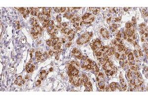 ABIN6278853 at 1/100 staining Human liver cancer tissue by IHC-P. (CALY antibody  (Internal Region))