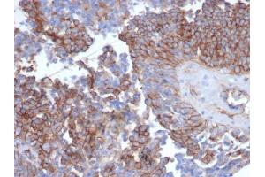 Formalin-fixed, paraffin-embedded human ovarian carcinoma stained with N-Cadherin Recombinant Rabbit Monoclonal Antibody (CDH2/6857R). (Recombinant N-Cadherin antibody)