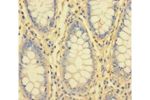 Immunohistochemistry of paraffin-embedded human colon cancer using ABIN7156759 at dilution of 1:100 (IL1RL2 antibody  (AA 20-218))