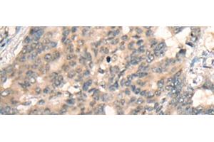Immunohistochemistry of paraffin-embedded Human liver cancer tissue using BBOX1 Polyclonal Antibody at dilution of 1:45(x200)