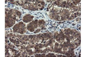 Immunohistochemical staining of paraffin-embedded Adenocarcinoma of Human ovary tissue using anti-MLF1 mouse monoclonal antibody. (MLF1 antibody)