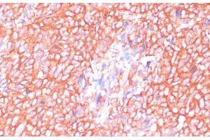 Immunohistochemistry of paraffin-embedded Human oophoroma using MOB4 Polyclonal Antibody at dilution of 1:100 (40x lens). (MOBKL3 antibody)
