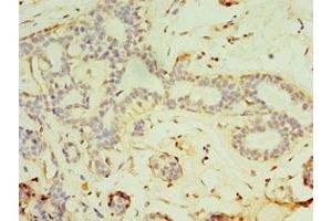 Immunohistochemistry of paraffin-embedded human breast cancer using ABIN7152819 at dilution of 1:100 (FGF6 antibody  (AA 38-208))