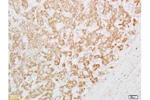 Formalin-fixed and paraffin embedded human liver carcinoma labeled with Rabbit Anti CPE/Carboxypeptidase H Polyclonal Antibody, Unconjugated (ABIN1387591) at 1:200 followed by conjugation to the secondary antibody and DAB staining