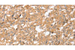 Immunohistochemistry of paraffin-embedded Human thyroid cancer using AHSG Polyclonal Antibody at dilution of 1:60 (Fetuin A antibody)