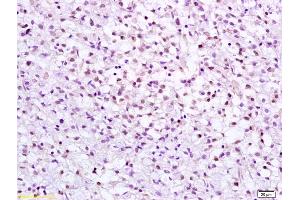 Formalin-fixed and paraffin embedded human gastric carcinoma labeled with Anti CHK2 Polyclonal Antibody, Unconjugated (ABIN685867) at 1:200 followed by conjugation to the secondary antibody and DAB staining (CHEK2 antibody  (AA 101-250))