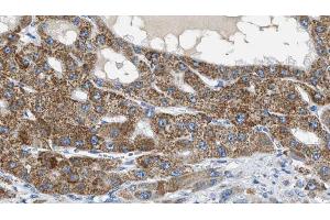 ABIN6269254 at 1/100 staining Human liver cancer tissue by IHC-P. (ZAP70 antibody  (Internal Region))