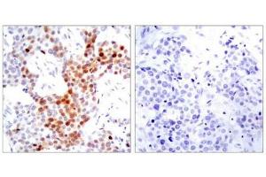 Immunohistochemical analysis of paraffin-embedded human breast carcinoma tissue using ATF2(Phospho-Thr69 or 51) Antibody(left) or the same antibody preincubated with blocking peptide(right). (ATF2 antibody  (pThr69))
