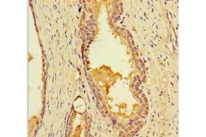 Immunohistochemistry of paraffin-embedded human prostate cancer using ABIN7158346 at dilution of 1:100 (LIMS3 antibody  (AA 1-117))