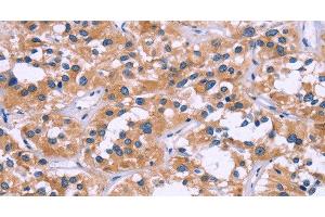 Immunohistochemistry of paraffin-embedded Human thyroid cancer tissue using ZEB2 Polyclonal Antibody at dilution 1:60 (ZEB2 antibody)