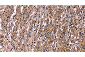 Immunohistochemistry of paraffin-embedded Human gastric cancer using SEPT7 Polyclonal Antibody at dilution of 1:50 (Septin 7 antibody)