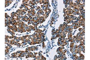 The image on the left is immunohistochemistry of paraffin-embedded Human breast cancer tissue using ABIN7129699(HINT2 Antibody) at dilution 1/50, on the right is treated with fusion protein.