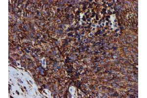 Immunohistochemical staining of paraffin-embedded Adenocarcinoma of Human breast tissue using anti-PDIA4 mouse monoclonal antibody. (PDIA4 antibody)