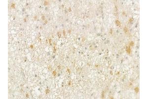 ABIN6261858 and ABIN6276889 at 1/100 staining human astrocytoma by IHC-P.