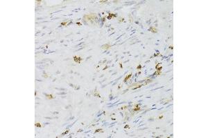 Immunohistochemistry of paraffin-embedded human adenomyosis using LSP1 Antibody (ABIN5973271) at dilution of 1/100 (40x lens). (LSP1 antibody)