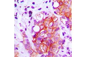 Immunohistochemical analysis of GAD1/2 staining in human breast cancer formalin fixed paraffin embedded tissue section. (GAD65+GAD67 (C-Term) antibody)