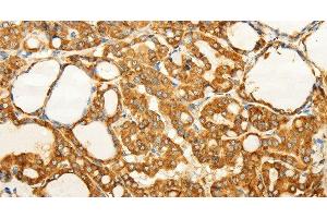 Immunohistochemistry of paraffin-embedded Human thyroid cancer tissue using FZD6 Polyclonal Antibody at dilution 1:60 (FZD6 antibody)