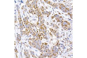 Immunohistochemistry of paraffin-embedded human esophageal cancer using MRPS15 Rabbit mAb (ABIN7268582) at dilution of 1:250 (40x lens). (MRPS15 antibody)