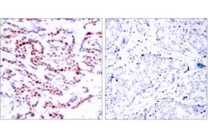 Immunohistochemistry analysis of paraffin-embedded human breast carcinoma, using ATF2 (Phospho-Ser112 or 94) Antibody. (ATF2 antibody  (pSer112))