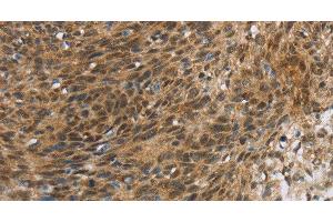 Immunohistochemistry of paraffin-embedded Human cervical cancer tissue using FOXB1 Polyclonal Antibody at dilution 1:30 (FOXB1 antibody)