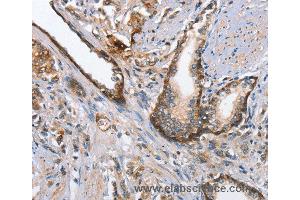 Immunohistochemistry of Human prostate cancer using MAD2L1BP Polyclonal Antibody at dilution of 1:65