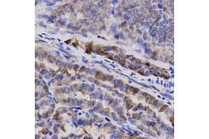 Immunohistochemistry of paraffin-embedded human thyroid cancer using SNCG antibody at dilution of 1:200 (x400 lens)