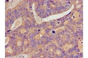 Immunohistochemistry of paraffin-embedded human colon cancer using ABIN7145766 at dilution of 1:100 (BCAR1 antibody  (AA 68-218))