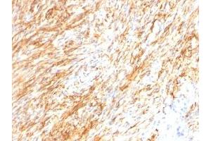 Formalin-fixed, paraffin-embedded human Schwanoma stained with GFAP antibody (GA-5 + ASTRO/789).