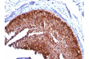 Formalin-fixed, paraffin-embedded human Bladder Carcinoma stained with CK17 Mouse Monoclonal Antibody (KRT17/778). (KRT17 antibody)