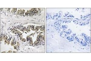 Immunohistochemistry analysis of paraffin-embedded human prostate carcinoma tissue, using GSPT1 Antibody. (GSPT1 antibody  (AA 101-150))