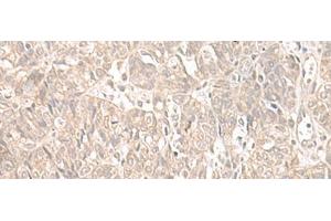 Immunohistochemistry of paraffin-embedded Human ovarian cancer tissue using ILKAP Polyclonal Antibody at dilution of 1:55(x200) (ILKAP antibody)