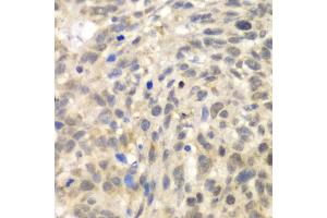 Immunohistochemistry of paraffin-embedded human esophageal cancer using TLK2 antibody.
