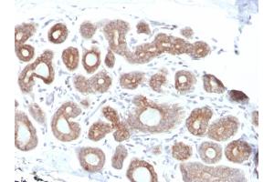 Formalin-fixed, paraffin-embedded human Breast Carcinoma stained with Calpain 1 Mouse Monoclonal Antibody (CAPN1/1530). (CAPNL1 antibody)