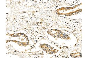 ABIN7094342 and ABIN7098389 at 1/100 staining Human pancreatic cancer by IHC-P.
