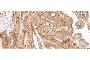 Immunohistochemistry of paraffin-embedded Human thyroid cancer tissue using MCAM Polyclonal Antibody at dilution of 1:40(x200) (MCAM antibody)