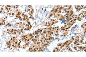 Immunohistochemistry of paraffin-embedded Human breast cancer tissue using ANXA10 Polyclonal Antibody at dilution 1:35 (Annexin a10 antibody)