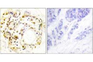 Immunohistochemistry analysis of paraffin-embedded human breast carcinoma, using ERK3 (Phospho-Ser189) Antibody. (MAPK6 antibody  (pSer189))