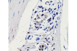 Immunohistochemistry of paraffin-embedded Human gastric cancer using p27 KIP 1 Polyclonal Antibody at dilution of 1:100 (40x lens). (CDKN1B antibody)