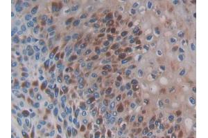IHC-P analysis of Human Skin cancer Tissue, with DAB staining. (CCL3L1 antibody  (AA 1-93))