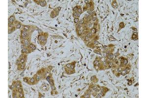 Immunohistochemistry of paraffin-embedded human liver cancer using TNFSF13 antibody. (TNFSF13 antibody)