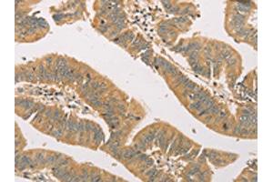 The image on the left is immunohistochemistry of paraffin-embedded Human colon cancer tissue using ABIN7131118(SNAP91 Antibody) at dilution 1/20, on the right is treated with fusion protein. (SNAP91 antibody)