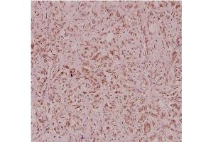 Immunohistochemistry analysis of Defensin alpha-3 Antibody in paraffin-embedded human breast carcinoma tissue at 1/100. (DEFa3 antibody)