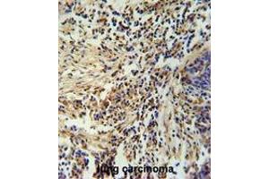 ZNF720 Antibody (Center) immunohistochemistry analysis in formalin fixed and paraffin embedded human lung carcinoma followed by peroxidase conjugation of the secondary antibody and DAB staining. (ZNF720 antibody  (Middle Region))