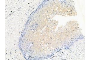 ABIN6256156 and ABIN6267546 at 1/100 staining human cervical carcinoma by IHC-P. (VASP antibody  (pSer157))