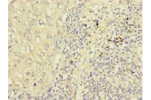 Immunohistochemistry of paraffin-embedded human liver cancer using ABIN7162859 at dilution of 1:100 (PPIL2 antibody  (AA 1-260))