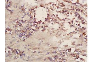 Formalin-fixed and paraffin embedded human lung carcinoma labeled with Rabbit Anti-CD101 Polyclonal Antibody, Unconjugated (ABIN2172703) at 1:200 followed by conjugation to the secondary antibody and DAB staining