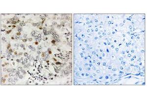 Immunohistochemistry analysis of paraffin-embedded human breast carcinoma tissue using CGREF1 antibody.