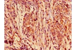 Immunohistochemistry of paraffin-embedded human pancreatic cancer using ABIN7150430 at dilution of 1:100 (POLR2C antibody  (AA 2-275))