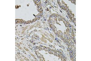 Immunohistochemistry of paraffin-embedded human prostate using TMC1 antibody (ABIN6134923, ABIN6149240, ABIN6149242 and ABIN6224704) at dilution of 1:100 (40x lens). (TMC1 antibody  (AA 600-700))