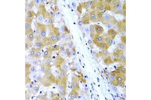 Immunohistochemistry of paraffin-embedded human liver cancer using TIRAP antibody (ABIN5971003) at dilution of 1/200 (40x lens). (TIRAP antibody)